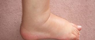 Опухла нога с температурой