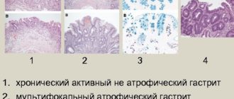 Очаговая неполная кишечная метаплазия эпителия желез