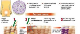 От ВПЧ не помогло дорогостоящее лекарство, почему? Что делать?