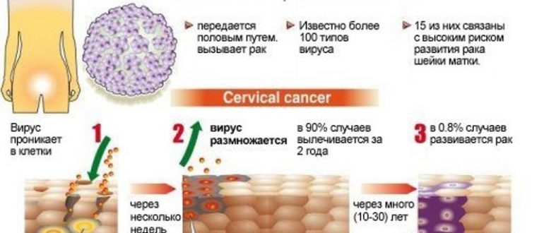 От ВПЧ не помогло дорогостоящее лекарство, почему? Что делать?