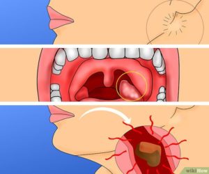 Опухла левая миндалина