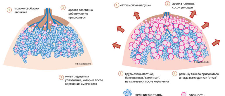 Грудь стала каменная на грудном вскармливании