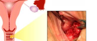 Образование на стенке влагалища