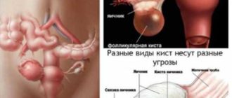 Фолликулярная киста при стимуляции с прегнилом