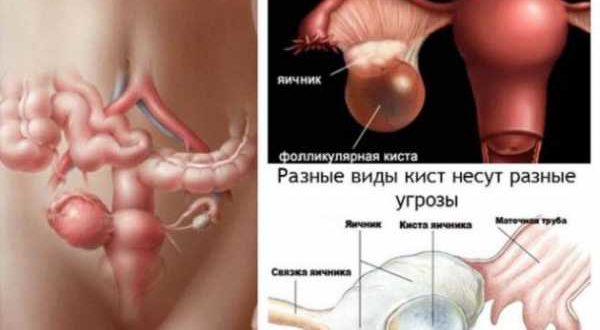 Фолликулярная киста при стимуляции с прегнилом