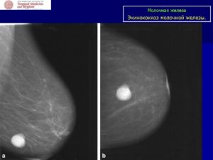 Очаговые образования молочных желез(кисты)