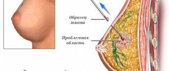 Нужна ли биопсия кисты в молочной железе?