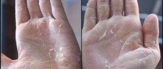 Облазит и чешется кожа рук