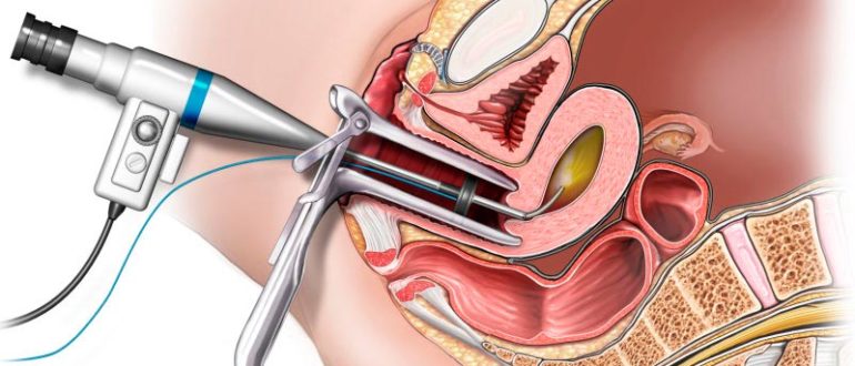 Гистерорезектоскопия