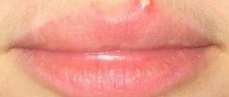 Небольшой красный прыщ на кайме верхней губы