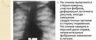 Фиброзная деформация легочного рисунка