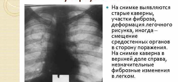 Фиброзная деформация легочного рисунка