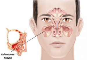 Гайморит. Инфильтрация гайморовых пазух