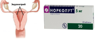 Норколут при гиперплазии