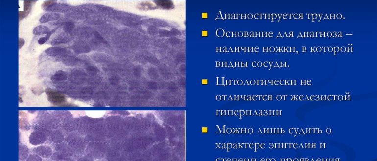 Фрагменты железистого полипа
