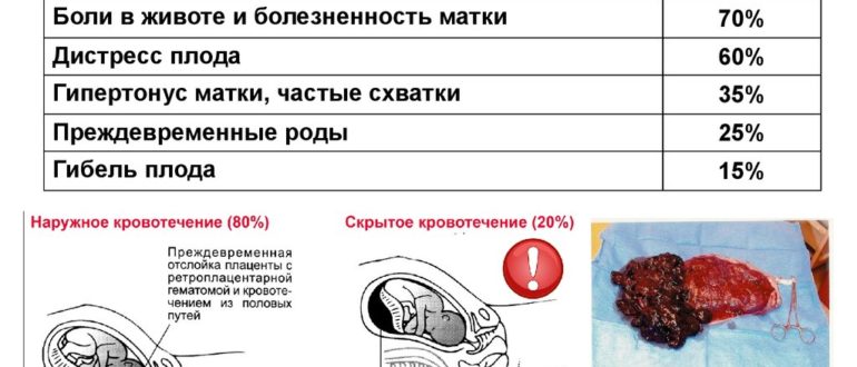 Отслойка плаценты смерть ребенка в 38 недель