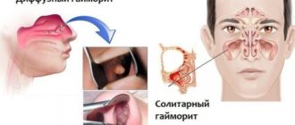 Непроходящий вялотекущий гайморит и евстахиит