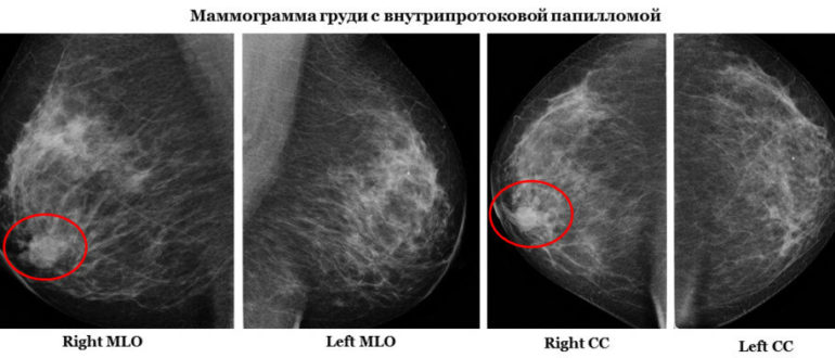 Папиллома в кисте молочной железы