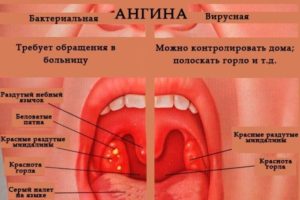 Не проходит кашель, долго красное горло