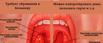 Не проходит кашель, долго красное горло