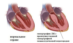 Гипертрофия межжелудочковой перегородки