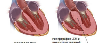 Гипертрофия межжелудочковой перегородки