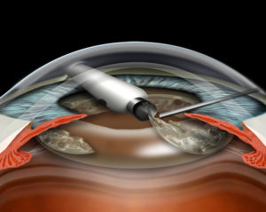 Операция после факоэмульсификации глаза