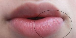 Опухла внутренняя половая губа с внешней стороны