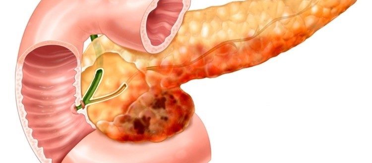 Панкреатит или нет его?