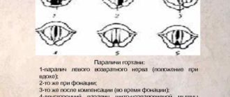 Парез возвратного нерва