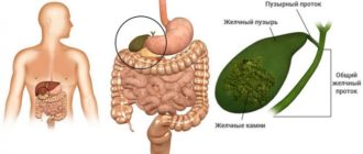 ФГС, камни в желчном пузыре