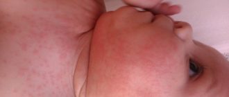Опрелость или аллергия?