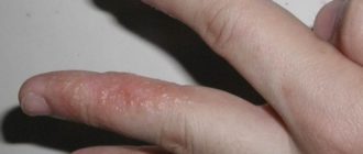 Недолеченный грибок на пальцах рук в виде водянистых пузырьков