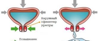 Недержание мочи после операции ТУР аденомы простаты