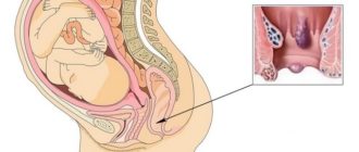 Геморрой при беременности