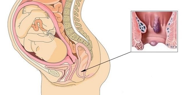 Геморрой при беременности