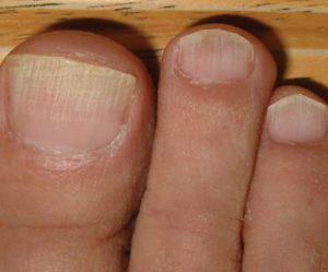 Грибок ногтей лечу почти 1 год