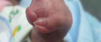 Открыли головку малышу