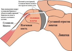 Нужна ли операция при разрыве сухожилия длинной головки плеча?