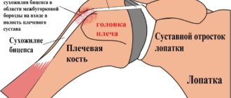 Нужна ли операция при разрыве сухожилия длинной головки плеча?