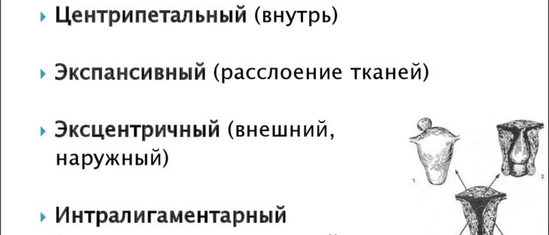 Определяется ли размер узла при центрипетальном росте?