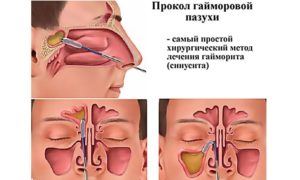 Гайморит, лечение антибиотиками или прокол?