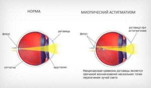 Головная боль миопический астигматизм