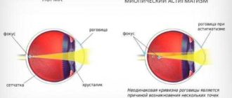 Головная боль миопический астигматизм