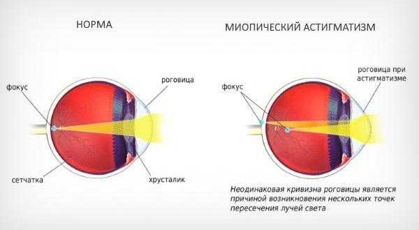 Головная боль миопический астигматизм