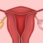 Гистология после внематочной беременности
