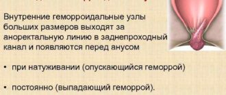 Геморрой или Выпадение толстой кишки