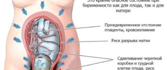 Гипертонус задней стенки матки