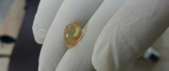 Не вышло околоплодное яйцо при медикаментозном аборте