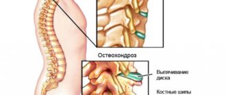 Остеохондроз шейного отдела позвоночника